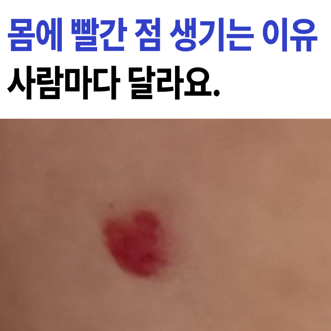 몸 에 붉은 점이 생기는 이유 '이 것'에 따라 치료 방법이 달라집니다. - 최신정보 몸 에 붉은 점이 생기는 이유 '이 것'에 따라 치료 방법이 달라집니다. - 최신정보