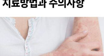 화염 상모 반 치료 방법과 주의 사항 알아야 합니다.